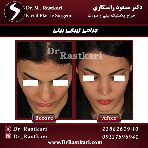 جراحی بینی دکتر راستکاری