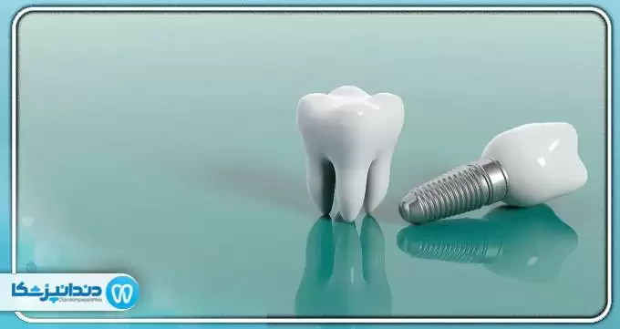 چه کسانی کاندید مناسبی برای ایمپلنت دندان نیستند؟
