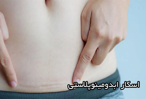جای بخیه ابدومینوپلاستی