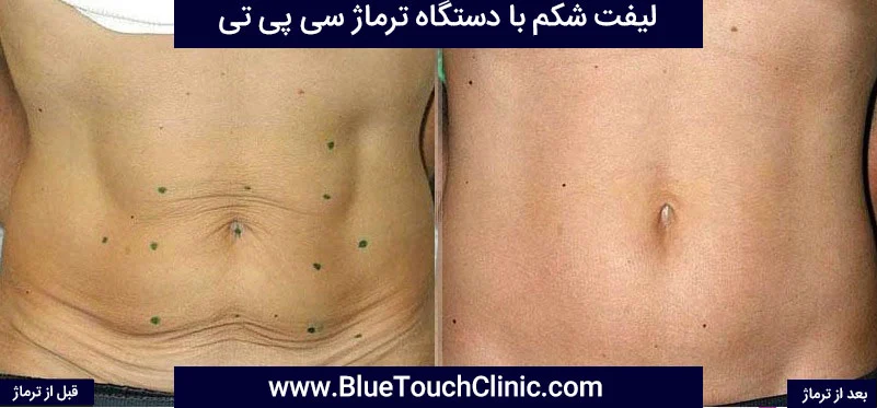 لیفت و جوانسازی پوست با دستگاه ترماژ